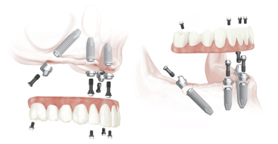 dental implants