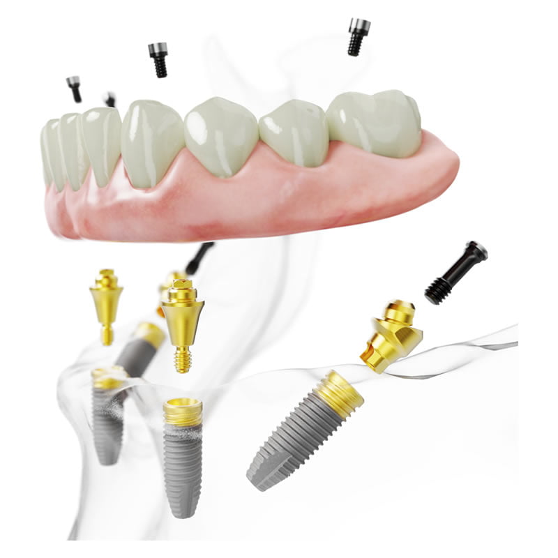 Full mouth reconstruction 