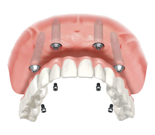 All On 4 Dental Implants